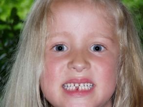 Eerste tand eruit